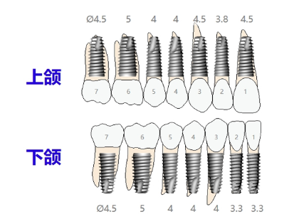 DIO 种植体系统/种植体UF(II) UF(II)3808S(种植体)